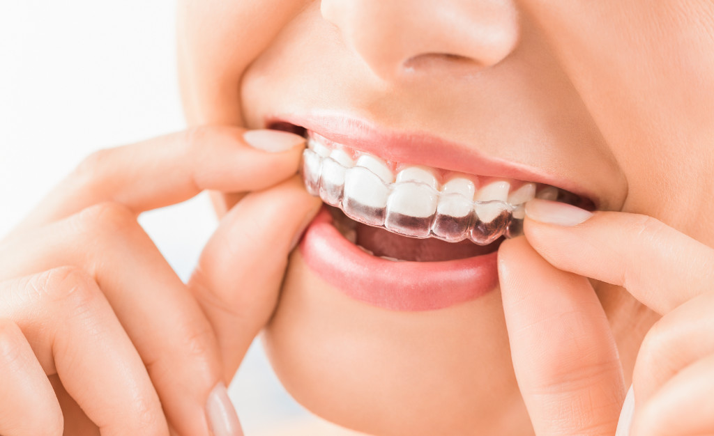 Allineatore invisibile: una delle possibili soluzioni di ortodonzia presso lo studio Dentistico Subiaco Salgarello